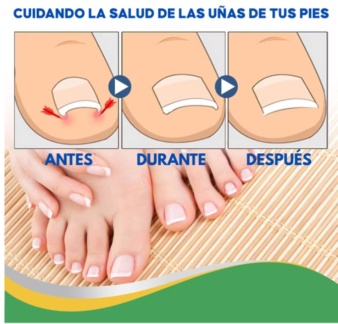 30 parches uña encarnada