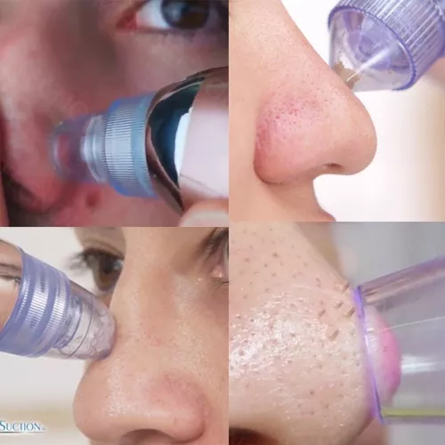 Miniatura 1 de Extractor De Puntos Negros Y Espinillas