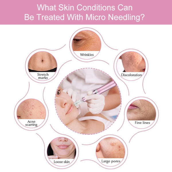 Miniatura 4 de Sistema Avanzado de Microneedling