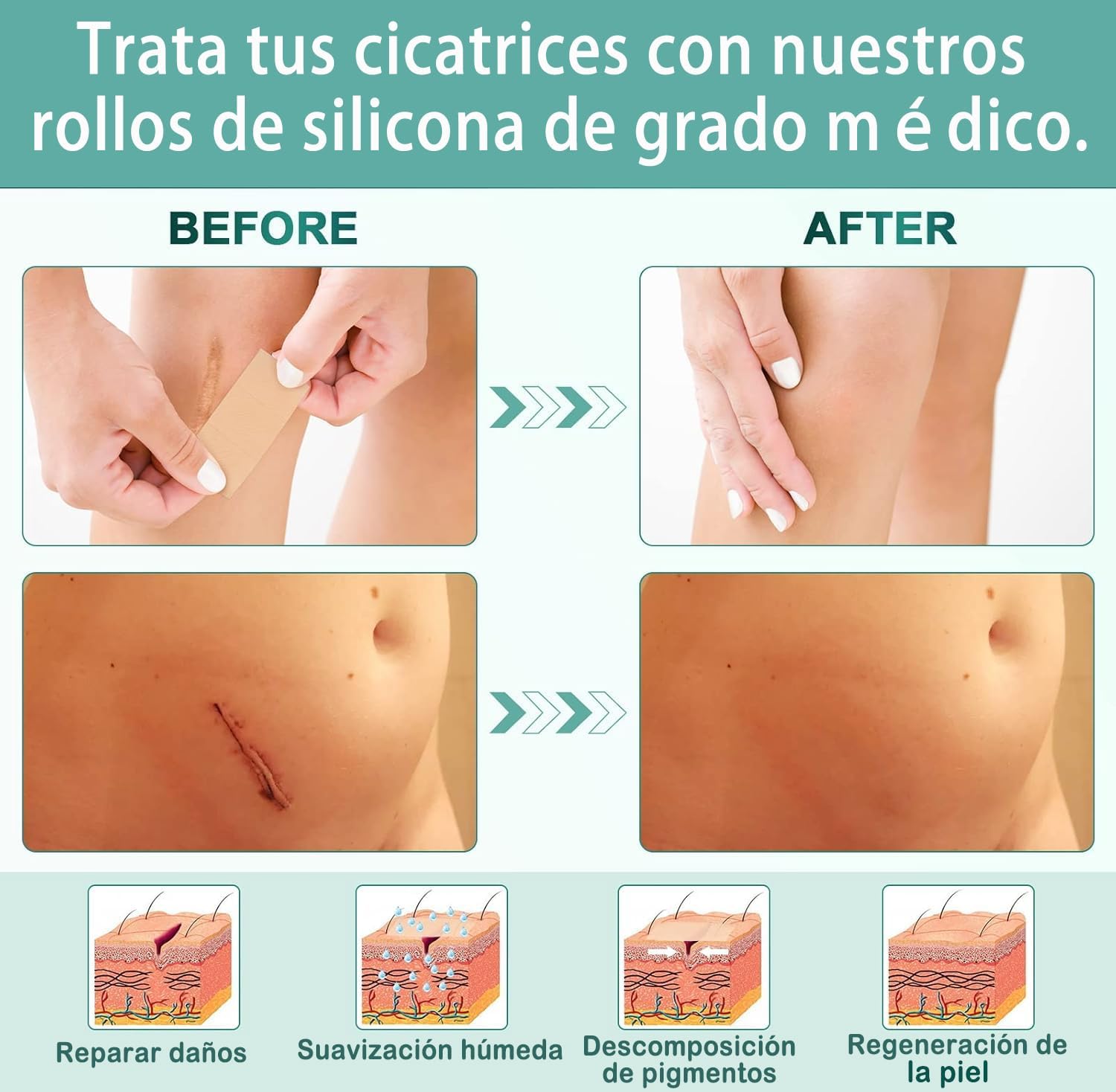 Láminas De Silicona Para Cicatrices