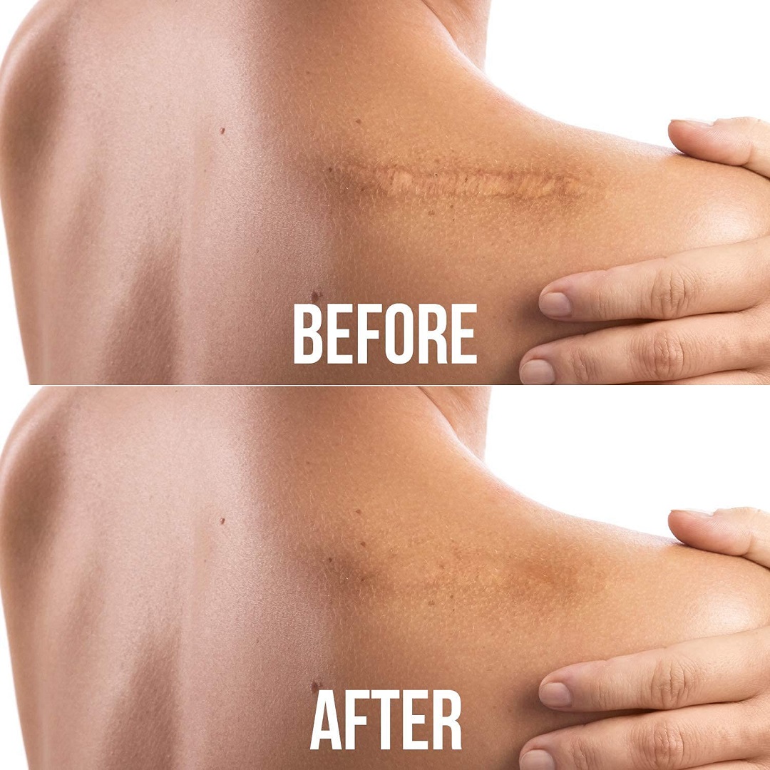 Cinta silicona eliminación de cicatrices