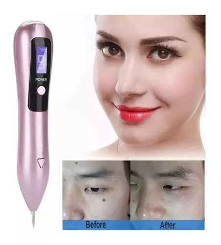 Miniatura 6 de Cauterizador Recargable Quita Verrugas