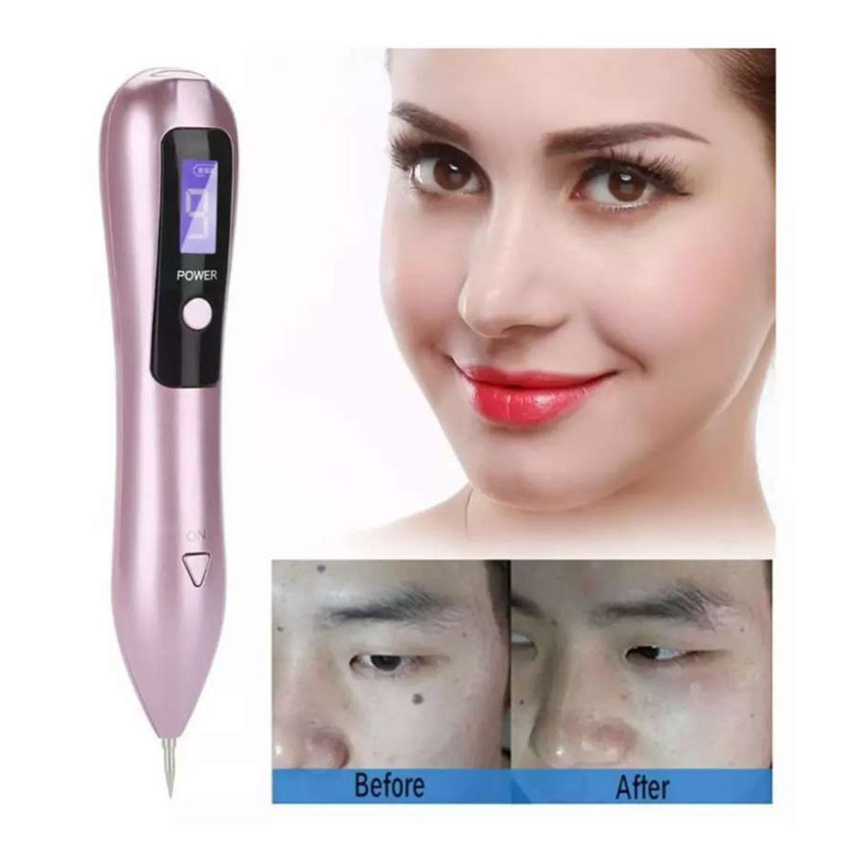Miniatura 4 de Cauterizador Quita Verrugas Pantalla Led