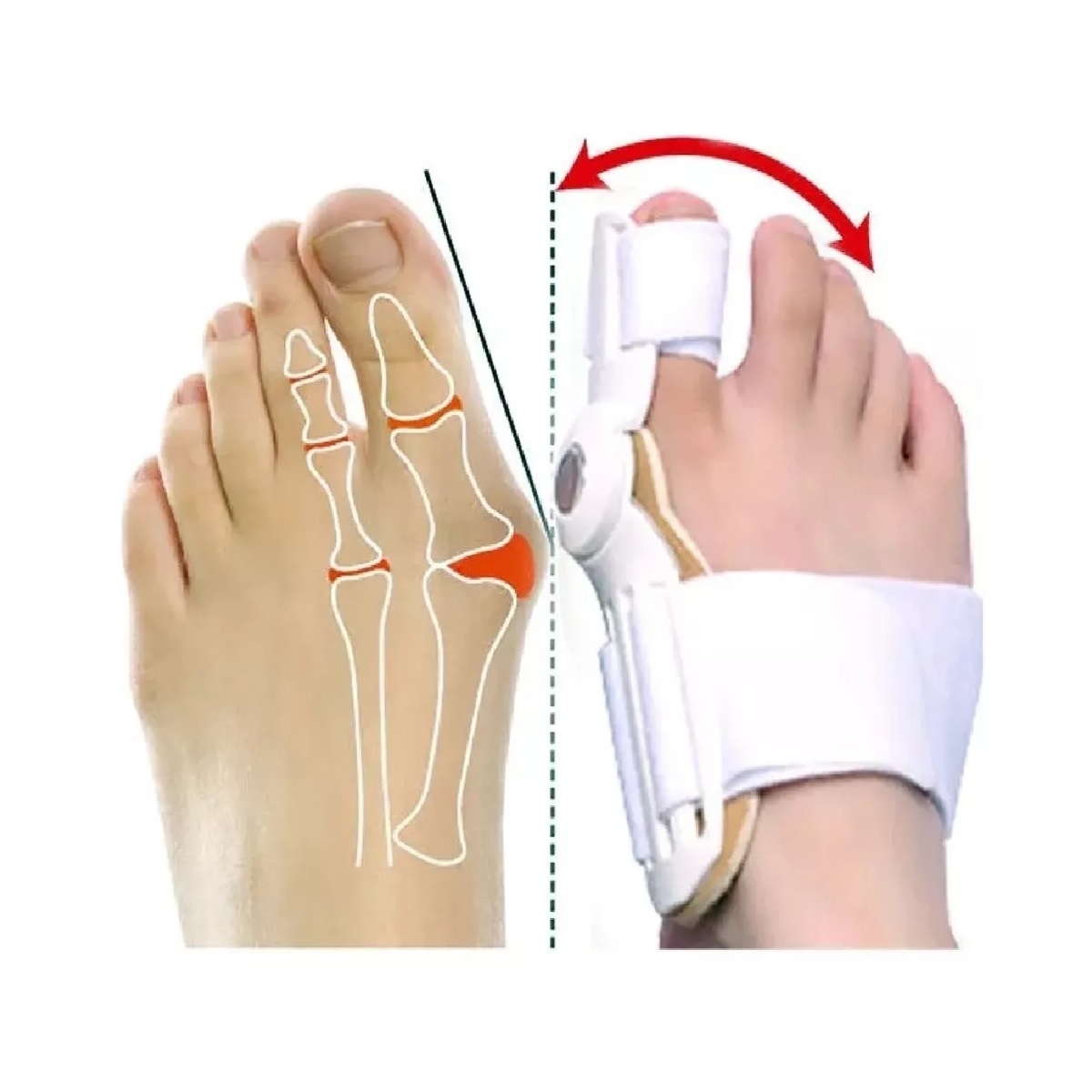 Miniatura 3 de Corrector de Juanetes Férula Alivio