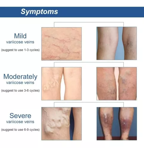 PARCHES VENAS VARICE X10