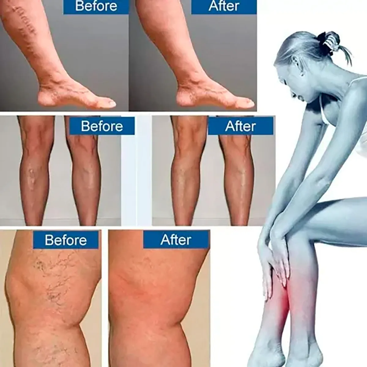 30 Parches de Varices para Circulacion disponible en Yaxa Mexico